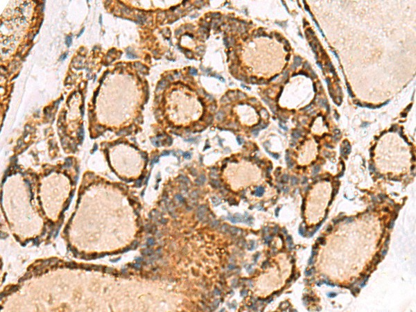 Immunohistochemistry of paraffin-embedded Human thyroid cancer tissue  using NPC2 Polyclonal Antibody at dilution of 1:50(?200)