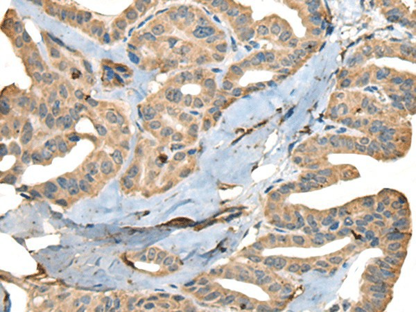 Immunohistochemistry of paraffin-embedded Human thyroid cancer tissue  using CDADC1 Polyclonal Antibody at dilution of 1:40(?200)