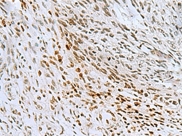 Immunohistochemistry of paraffin-embedded Human lung cancer tissue  using CNOT7 Polyclonal Antibody at dilution of 1:55(?200)