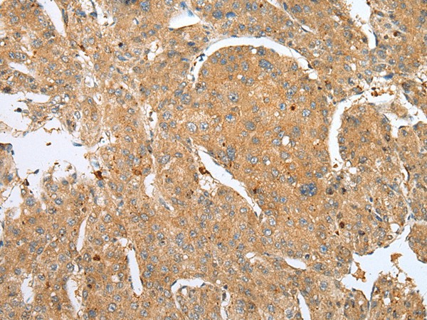 Immunohistochemistry of paraffin-embedded Human liver cancer tissue  using DCX Polyclonal Antibody at dilution of 1:30(?200)