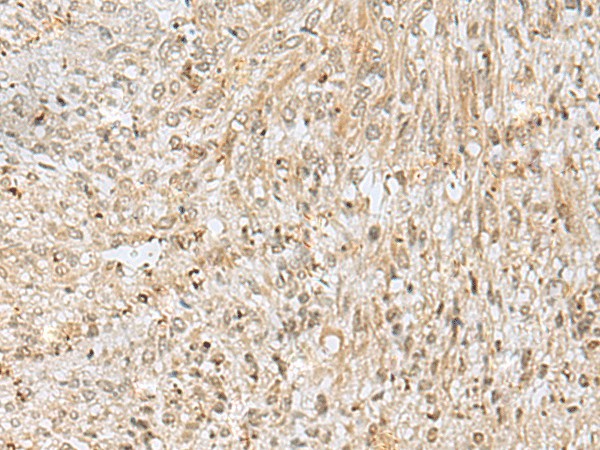 Immunohistochemistry of paraffin-embedded Human liver cancer tissue  using NUP58 Polyclonal Antibody at dilution of 1:50(?200)