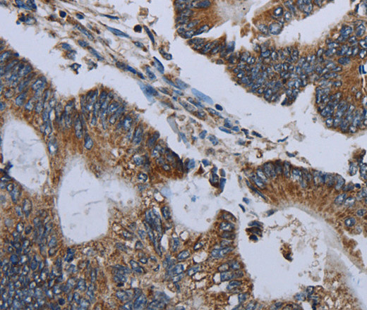 Immunohistochemistry of paraffin-embedded Human colon cancer using NDUFA13 Polyclonal Antibody at dilution of 1:50