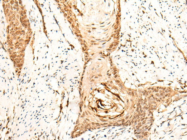 Immunohistochemistry of paraffin-embedded Human esophagus cancer tissue  using EMSY Polyclonal Antibody at dilution of 1:25(?200)