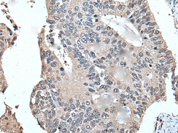 Immunohistochemistry of paraffin-embedded Human colorectal cancer tissue  using UFM1 Polyclonal Antibody at dilution of 1:45(?200)