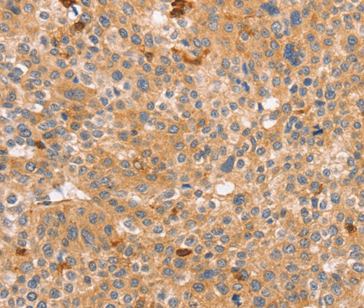 Immunohistochemistry of paraffin-embedded Human liver cancer tissue using CCL16  Polyclonal Antibody at dilution 1:60