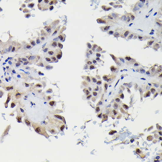 Immunohistochemistry of paraffin-embedded human thyroid cancer using SNRPE Polyclonal antibody at dilution of 1:50 (40x lens).Perform high pressure antigen retrieval with 10 mM citrate buffer pH 6.0 before commencing with IHC staining protocol.