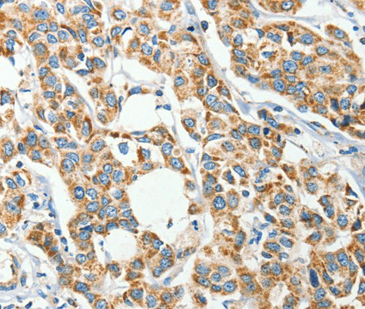 Immunohistochemistry of paraffin-embedded Human breast cancer tissue using IFT74 Polyclonal Antibody at dilution 1:60