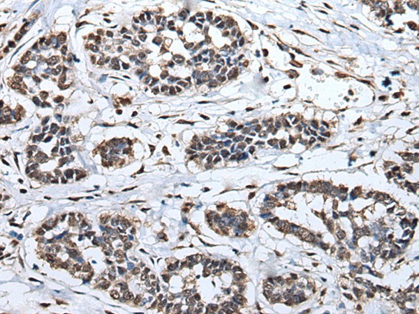 Immunohistochemistry of paraffin-embedded Human esophagus cancer tissue  using HNRNPH2 Polyclonal Antibody at dilution of 1:40(?200)