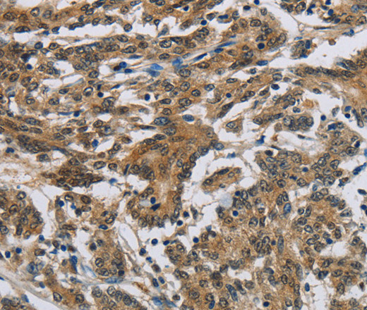 Immunohistochemistry of paraffin-embedded Human colon cancer using SYN1 Polyclonal Antibody at dilution of 1:50