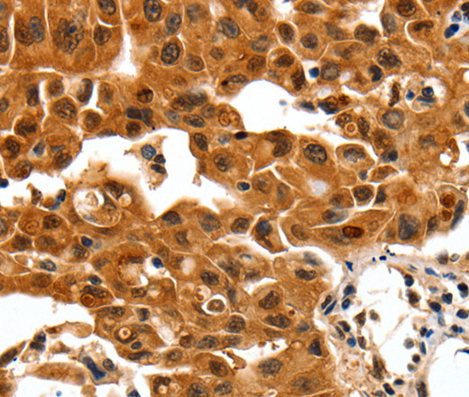 Immunohistochemistry of paraffin-embedded Human lung cancer using 14-3-3 beta/alpha Polyclonal Antibody at dilution of 1:30