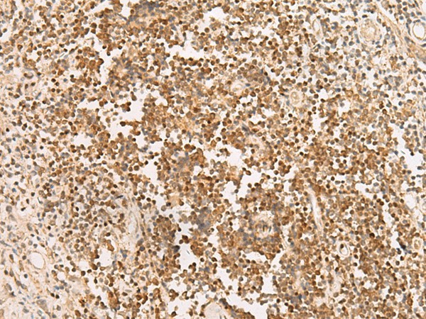 Immunohistochemistry of paraffin-embedded Human prost at e cancer tissue  using PAX5 Polyclonal Antibody at dilution of 1:30(?200)