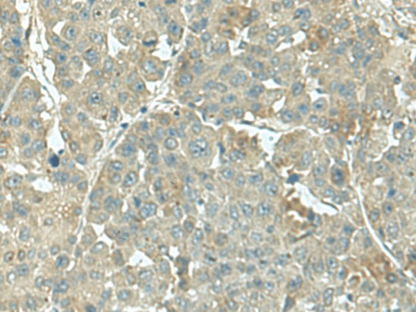 Immunohistochemistry of paraffin-embedded Human liver cancer tissue  using KRT36 Polyclonal Antibody at dilution of 1:55(?200)