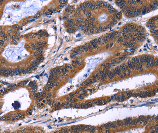 Immunohistochemistry of paraffin-embedded Human colon cancer using IL1A Polyclonal Antibody at dilution of 1:60