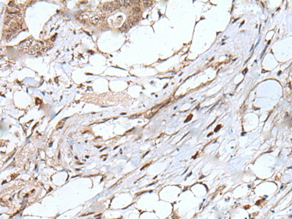 Immunohistochemistry of paraffin-embedded Human colorectal cancer tissue  using UBN1 Polyclonal Antibody at dilution of 1:75(?200)