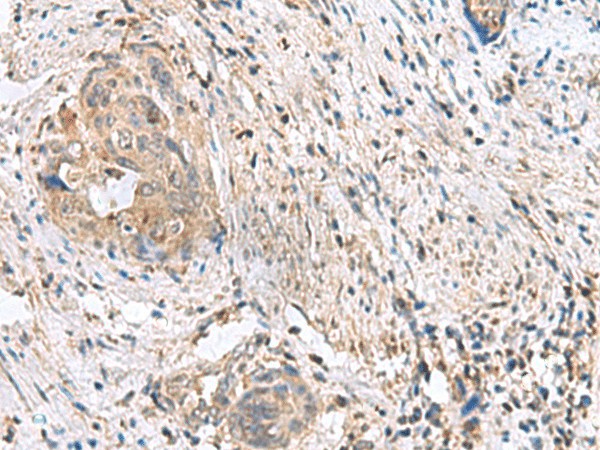 Immunohistochemistry of paraffin-embedded Human cervical cancer tissue  using STK32A Polyclonal Antibody at dilution of 1:90(?200)