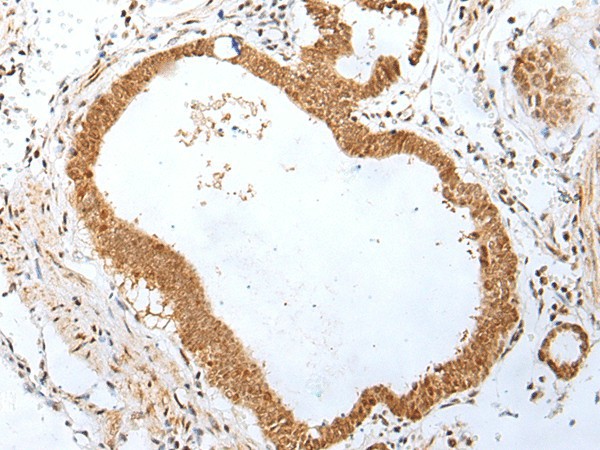 Immunohistochemistry of paraffin-embedded Human gastric cancer tissue  using PEG3 Polyclonal Antibody at dilution of 1:45(?200)