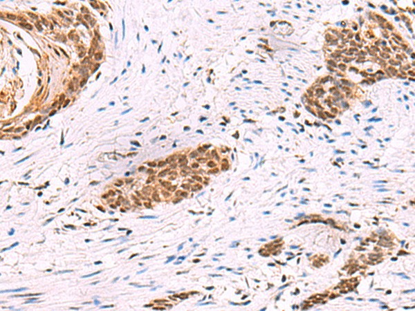 Immunohistochemistry of paraffin-embedded Human esophagus cancer tissue  using CREBBP Polyclonal Antibody at dilution of 1:35(?200)