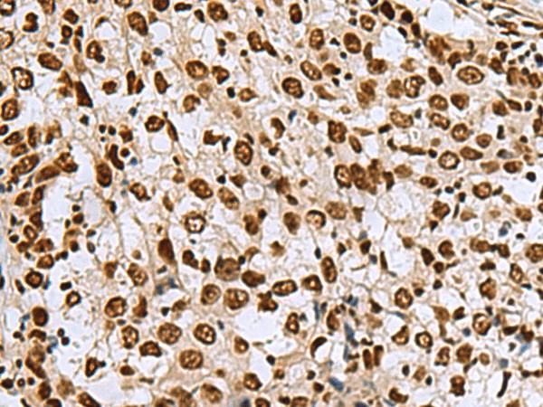 Immunohistochemistry of paraffin-embedded Human esophagus cancer tissue  using MYEF2 Polyclonal Antibody at dilution of 1:70(?200)