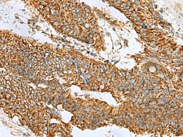 Immunohistochemistry of paraffin-embedded Human colorectal cancer tissue  using PREPL Polyclonal Antibody at dilution of 1:60(?200)