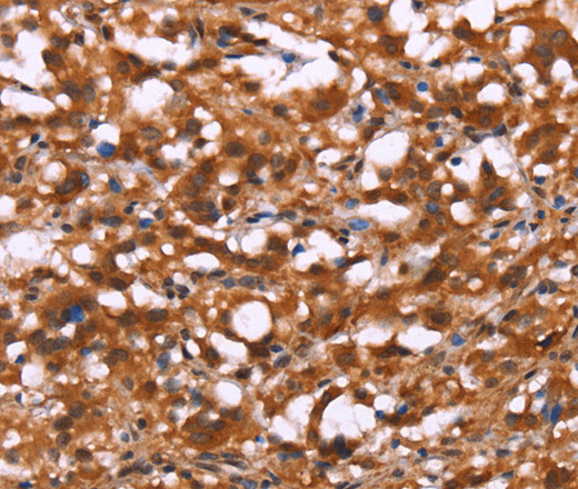 Immunohistochemistry of paraffin-embedded Human thyroid cancer using BRK1 Polyclonal Antibody at dilution of 1:40