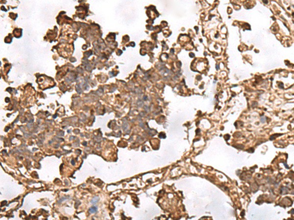 Immunohistochemistry of paraffin-embedded Human lung cancer tissue  using FAAP24 Polyclonal Antibody at dilution of 1:30(?200)