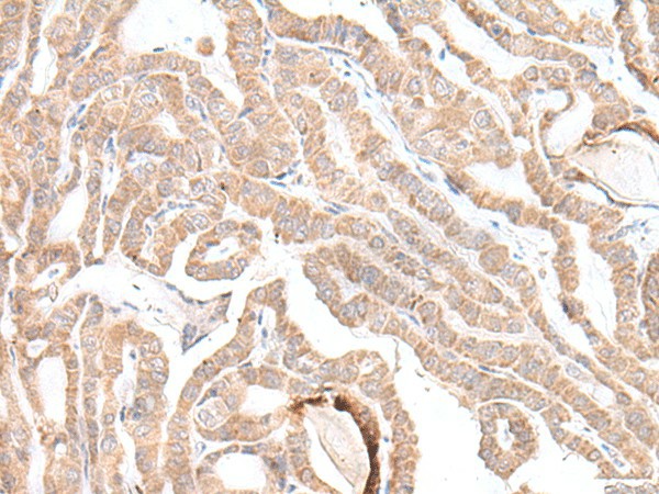 Immunohistochemistry of paraffin-embedded Human thyroid cancer tissue  using PLGLB2 Polyclonal Antibody at dilution of 1:35(?200)