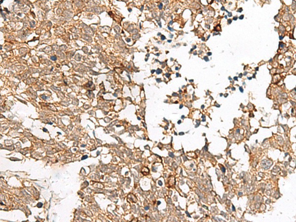 Immunohistochemistry of paraffin-embedded Human lung cancer tissue  using FAM84B Polyclonal Antibody at dilution of 1:45(?200)