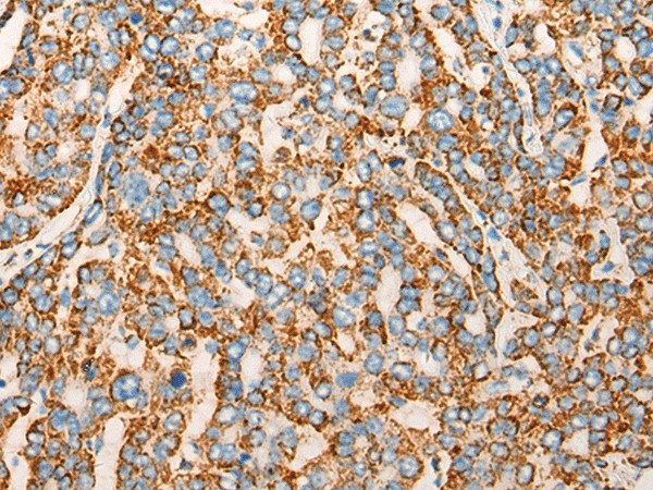 Immunohistochemistry of paraffin-embedded Human liver cancer tissue  using CHCHD3 Polyclonal Antibody at dilution of 1:45(?200)