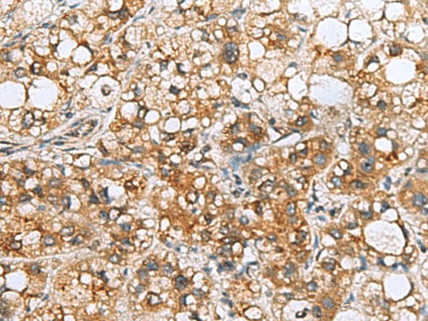 Immunohistochemistry of paraffin-embedded Human liver cancer tissue  using TMED10 Polyclonal Antibody at dilution of 1:65(?200)