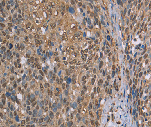 Immunohistochemistry of paraffin-embedded Human cervical cancer using CAB39 Polyclonal Antibody at dilution of 1:50