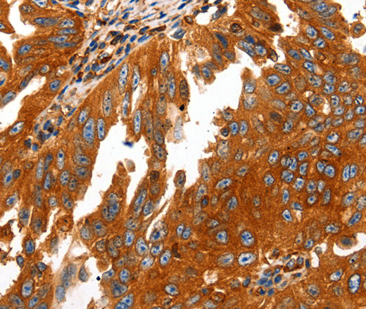 Immunohistochemistry of paraffin-embedded Human ovarian cancer using CAP2 Polyclonal Antibody at dilution of 1:50