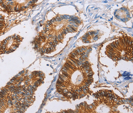 Immunohistochemistry of paraffin-embedded Human colon cancer tissue using CA9 Polyclonal Antibody at dilution 1:40