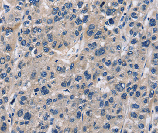 Immunohistochemistry of paraffin-embedded Human liver cancer tissue using ABI3BP Polyclonal Antibody at dilution 1:60