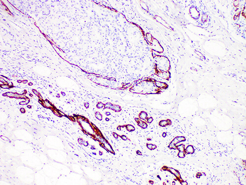 Immunohistochemistry of paraffinembedded Human breast cancer tissue with Calponin Monoclonal Antibody(Antigen repaired by EDTA).