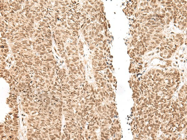 Immunohistochemistry of paraffin-embedded Human ovarian cancer tissue  using LGALS4 Polyclonal Antibody at dilution of 1:30(?200)