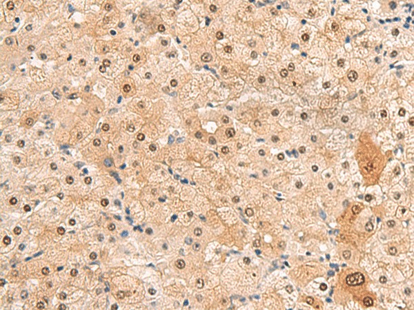 Immunohistochemistry of paraffin-embedded Human liver cancer tissue  using HEBP2 Polyclonal Antibody at dilution of 1:60(?200)