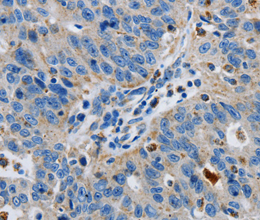 Immunohistochemistry of paraffin-embedded Human ovarian cancer tissue using GRIA3 Polyclonal Antibody at dilution 1:50