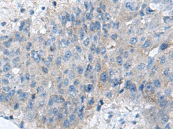 Immunohistochemistry of paraffin-embedded Human liver cancer tissue  using KIAA0556 Polyclonal Antibody at dilution of 1:70(?200)