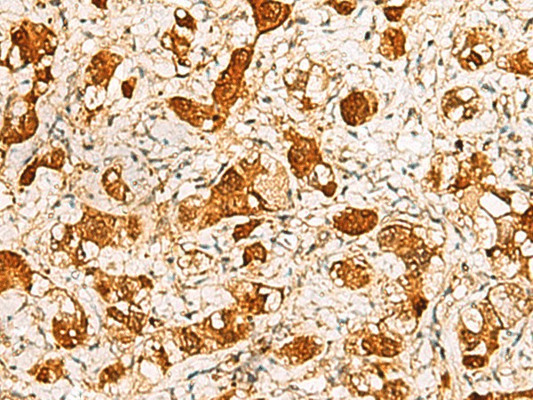 Immunohistochemistry of paraffin-embedded Human liver cancer tissue  using C11orf54 Polyclonal Antibody at dilution of 1:50(?200)