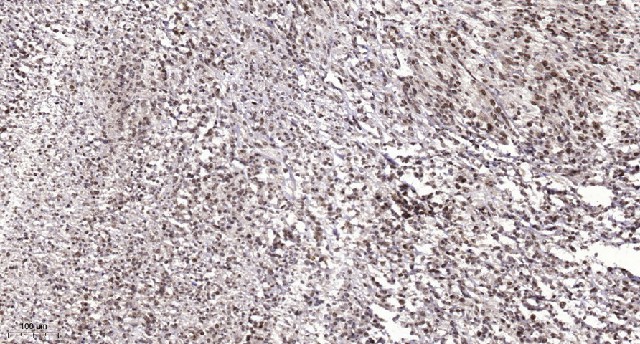 Immunohistochemistry analysis of paraffin-embedded human Colon cancer using p53 Polyclonal Antibody at dilution of 1:200(4? overnight).