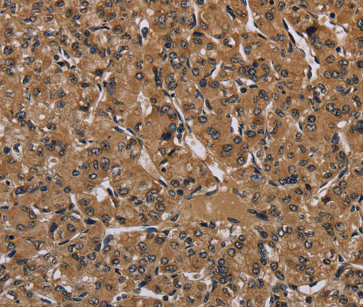 Immunohistochemistry of paraffin-embedded Human prostate cancer tissue using HIF1 alpha Polyclonal Antibody at dilution 1:60