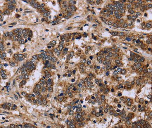 Immunohistochemistry of paraffin-embedded Human liver cancer using FH Polyclonal Antibody at dilution of 1:40