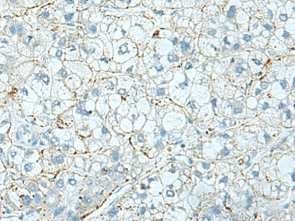 Immunohistochemistry of paraffin-embedded Human liver cancer tissue  using SHTN1 Polyclonal Antibody at dilution of 1:30(?200)