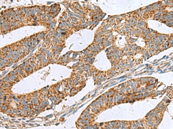 Immunohistochemistry of paraffin-embedded Human colorectal cancer tissue  using NFS1 Polyclonal Antibody at dilution of 1:50(?200)