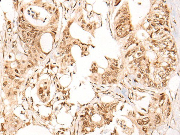 Immunohistochemistry of paraffin-embedded Human colorectal cancer tissue  using ARID1B Polyclonal Antibody at dilution of 1:40(?200)