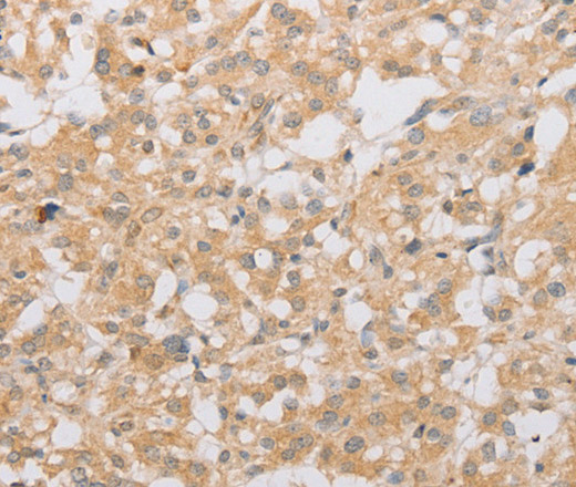 Immunohistochemistry of paraffin-embedded Human thyroid cancer tissue using ATG9A Polyclonal Antibody at dilution 1:40