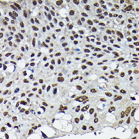 Immunohistochemistry of paraffin-embedded human lung cancer using CDK4 Polyclonal Antibody at dilution of 1:100 (40x lens).Perform high pressure antigen retrieval with 10 mM citrate buffer pH 6.0 before commencing with IHC staining protocol.