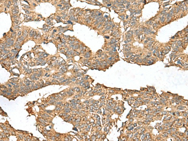 Immunohistochemistry of paraffin-embedded Human colorectal cancer tissue  using AHNAK Polyclonal Antibody at dilution of 1:50(?200)