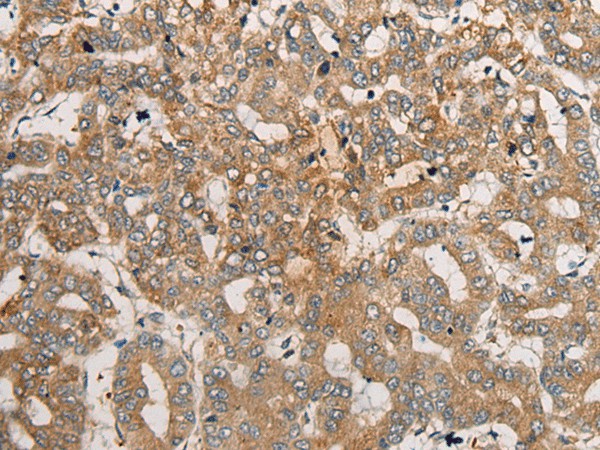 Immunohistochemistry of paraffin-embedded Human liver cancer tissue  using CEND1 Polyclonal Antibody at dilution of 1:50(?200)