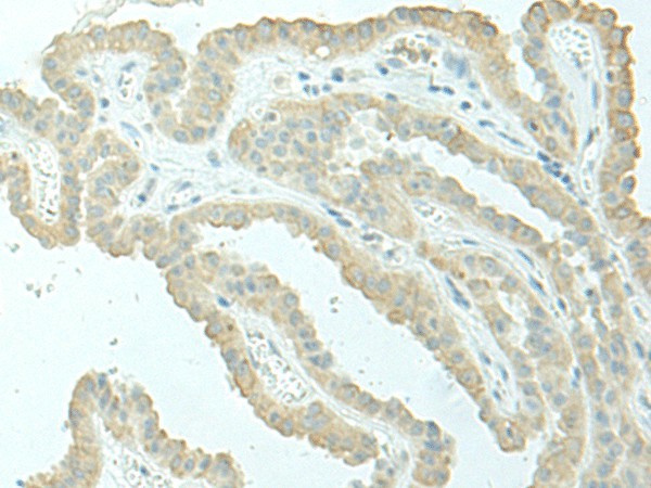 Immunohistochemistry of paraffin-embedded Human thyroid cancer tissue  using EVI2B Polyclonal Antibody at dilution of 1:40(?200)